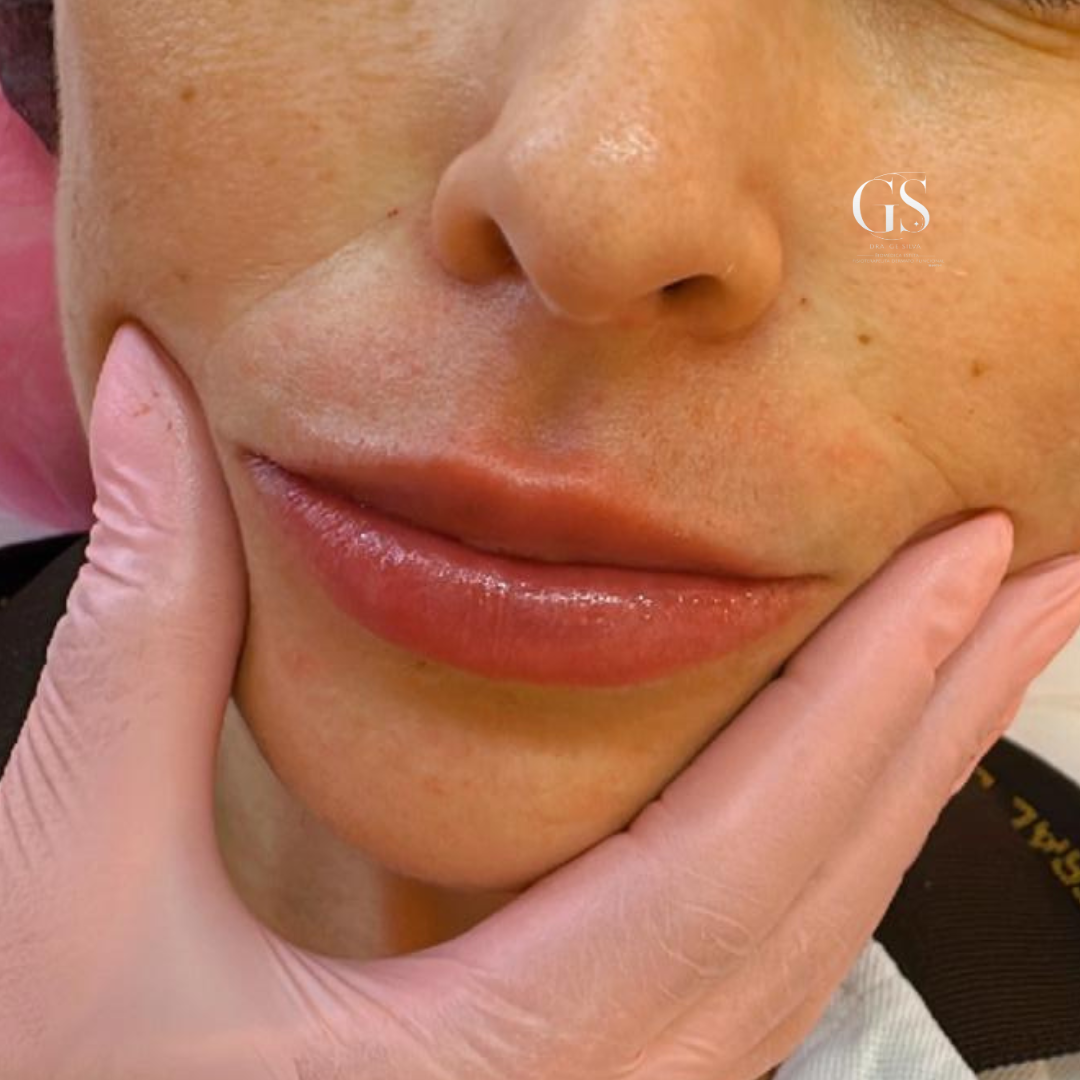 Preenchimento Labial